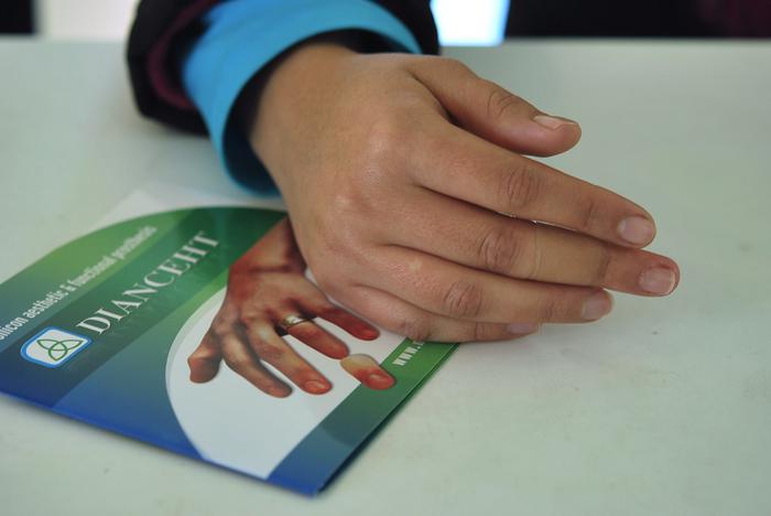 Finger prosthesis